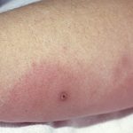 針治療後の感染症・・・施術にはリスクがあることも知ってください。