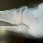 普通に歩けることがいかに生活にとって重要か・・・