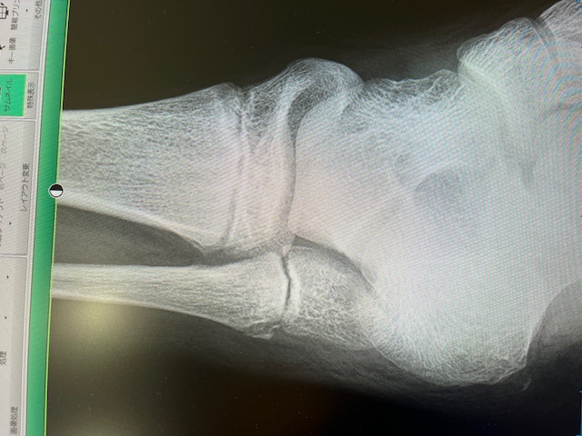 普通に歩けることがいかに生活にとって重要か・・・